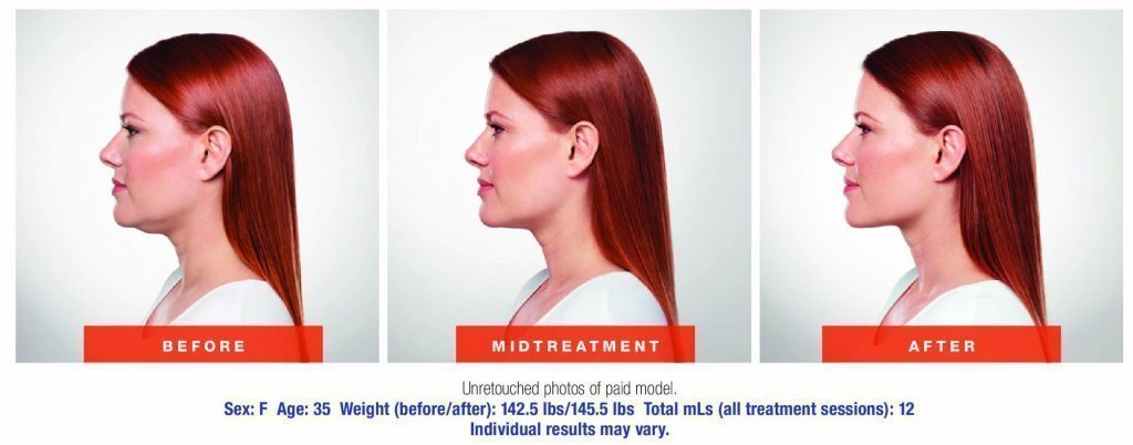 santesouthlake-kybella2 santesouthlake-kybella2