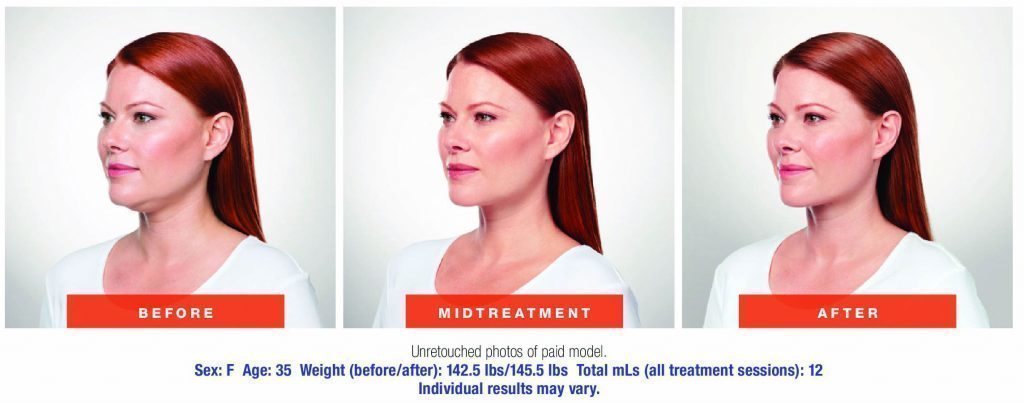 santesouthlake-kybella4 santesouthlake-kybella4