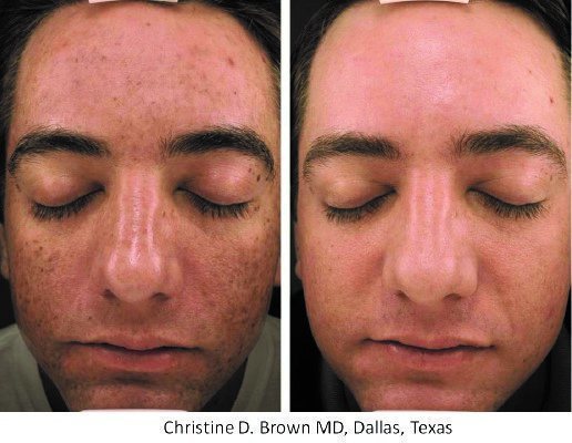 santesouthlake-microneedling5 santesouthlake-microneedling5