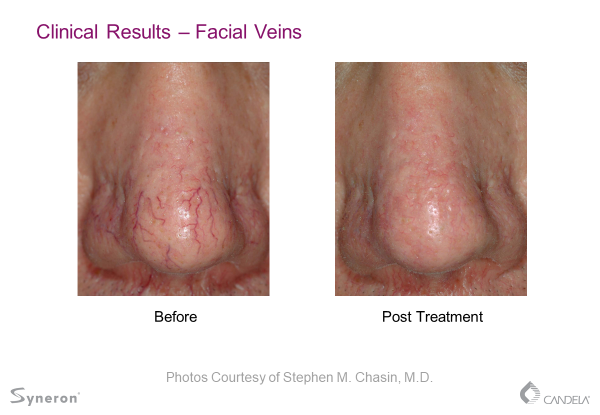 vein2 Laser Vein Treatment Before and After Sante