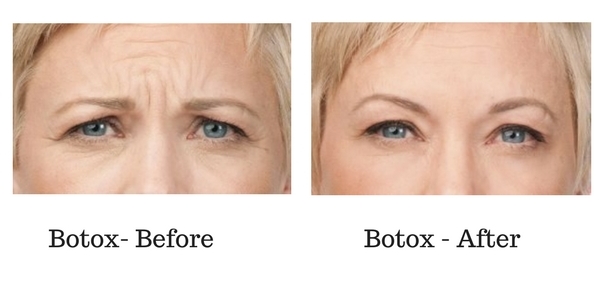 Botox Before and After Sante