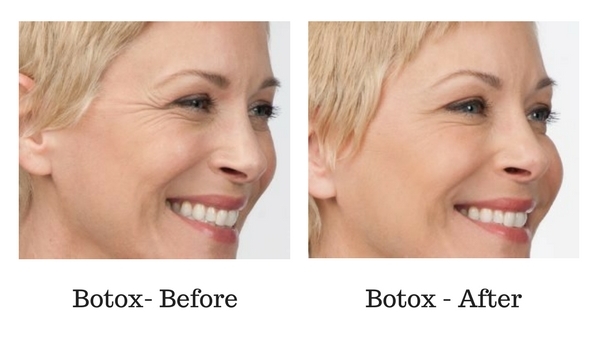 Botox Before and After Sante