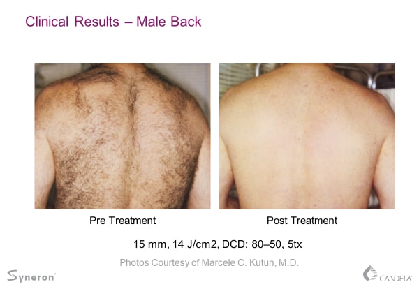 laser-hair-removal-before-and-after-sante-2 Laser Hair Removal Before and After Sante