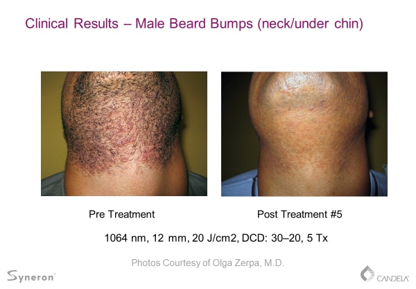 laser-hair-removal-before-and-after-sante-3 Laser Hair Removal Before and After Sante