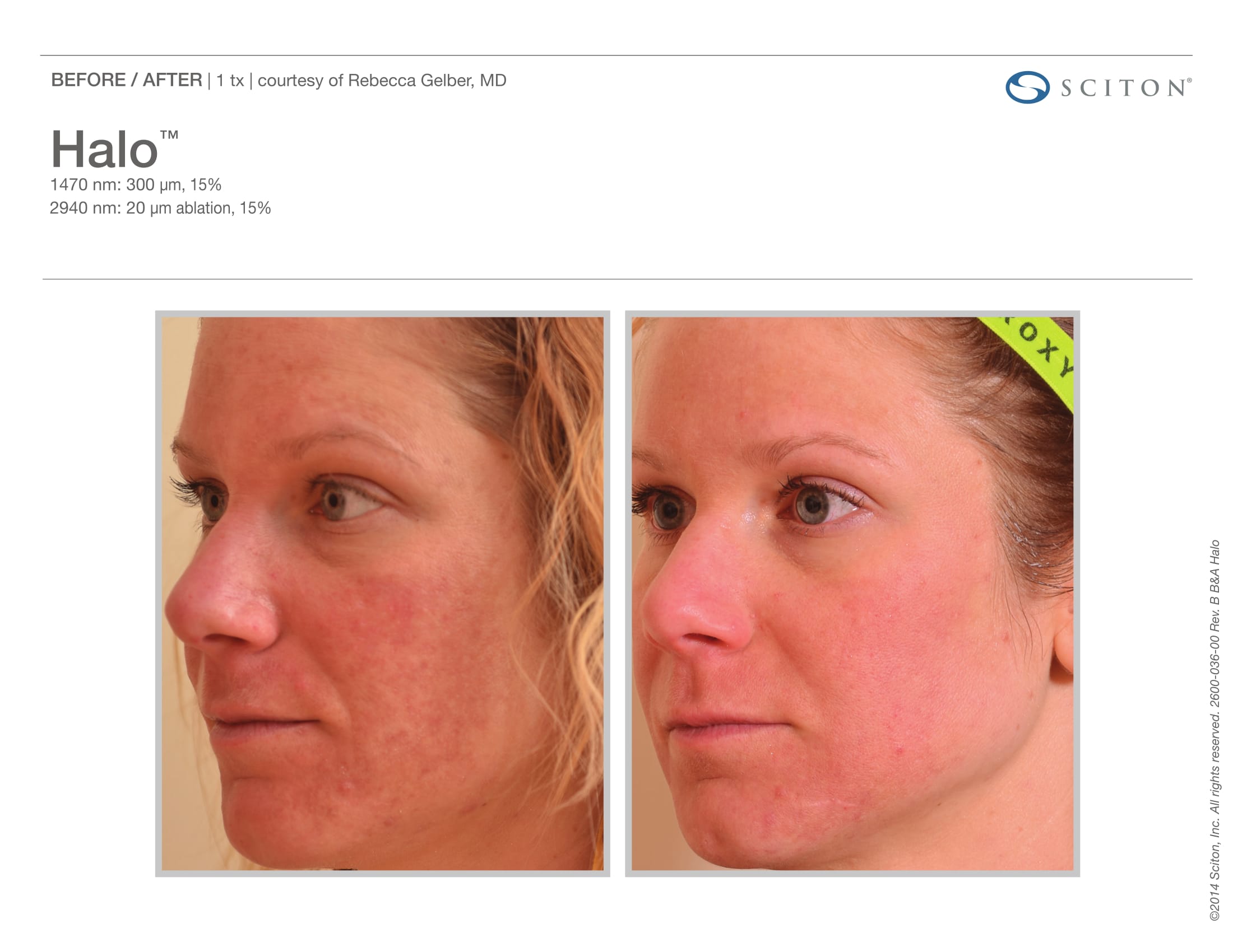 Laser Skin Resurfacing Before and After Sante
