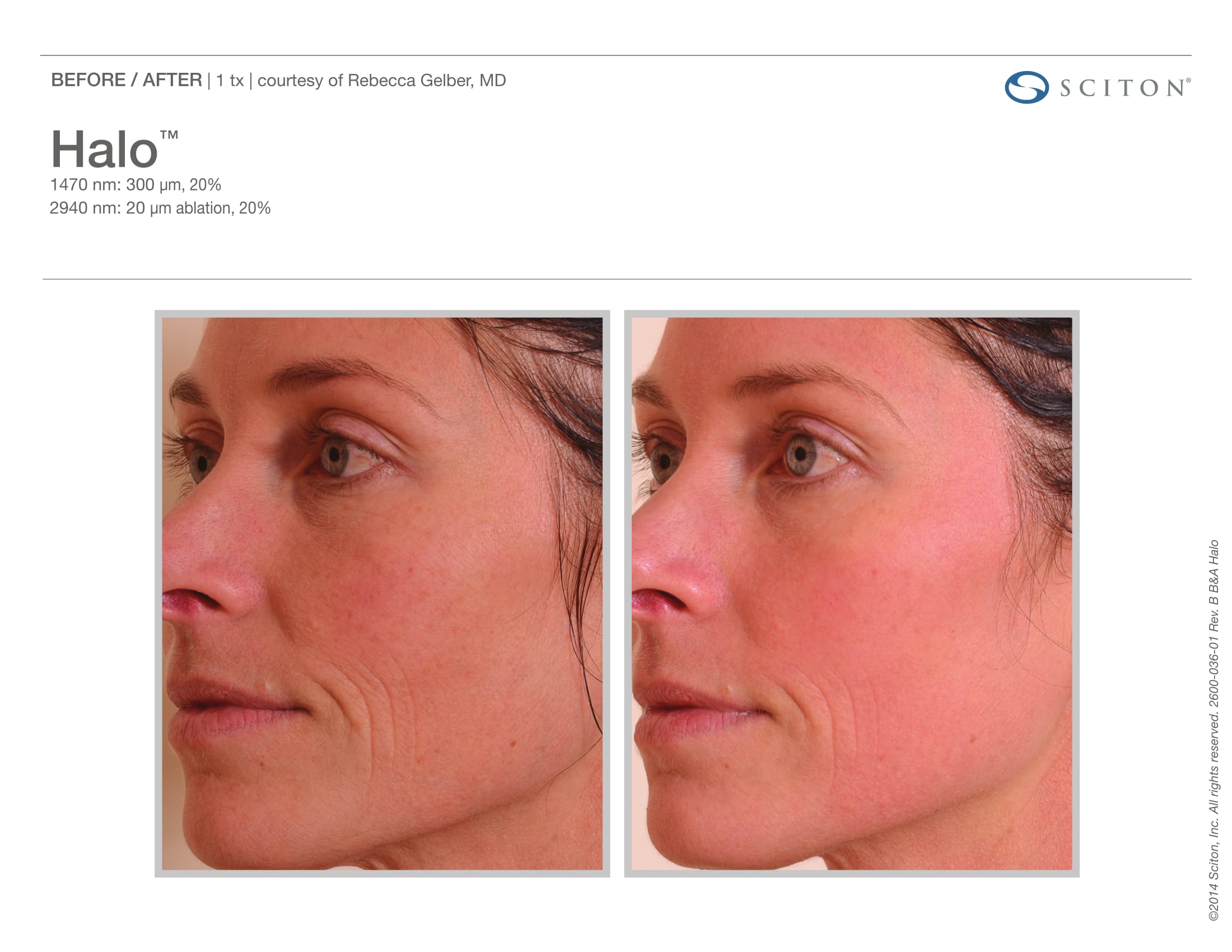 Laser Skin Resurfacing Before and After Sante
