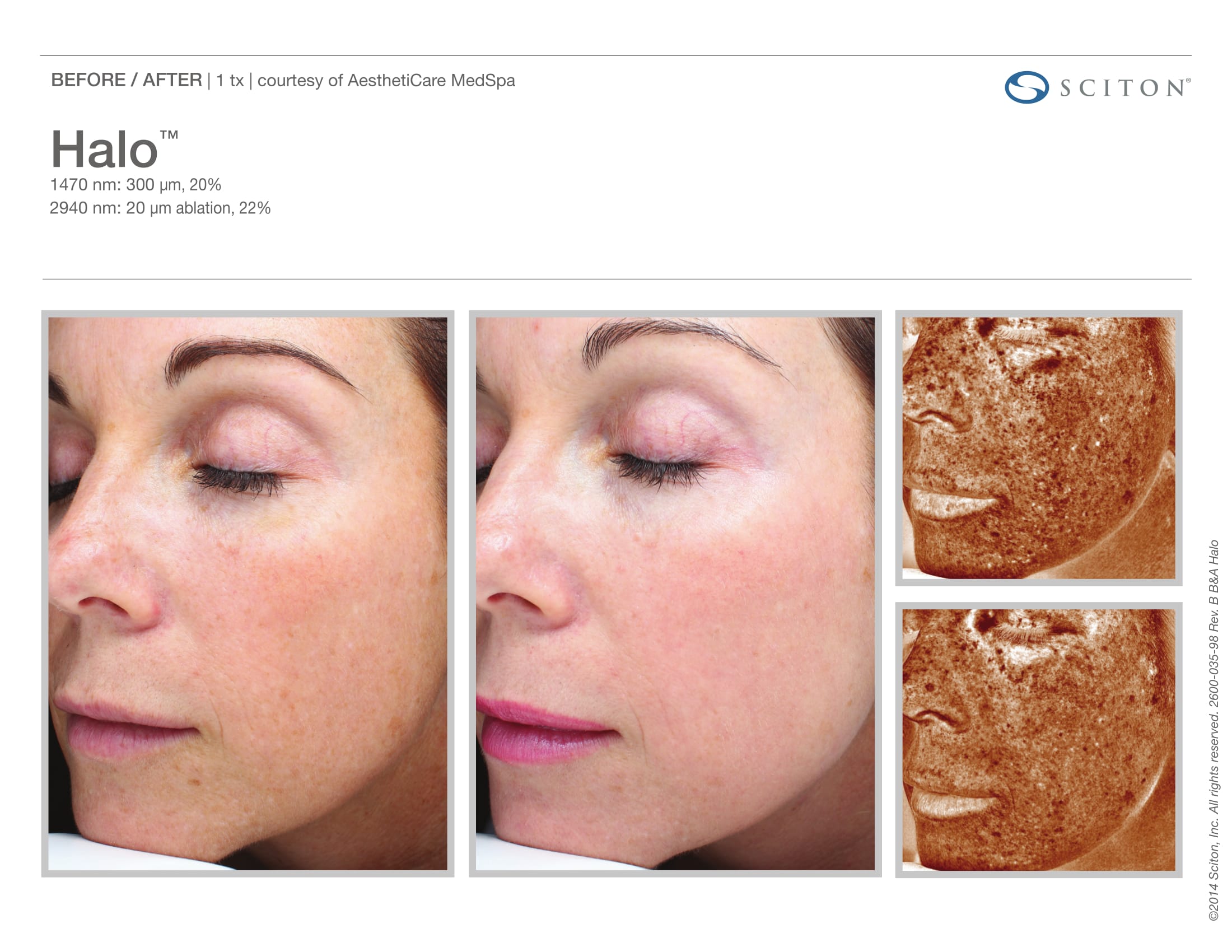 Laser Skin Resurfacing Before and After Sante