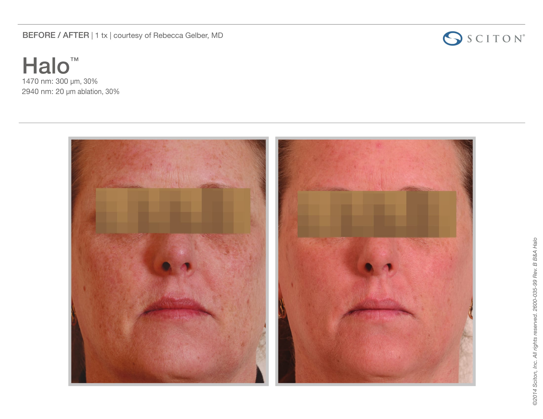 Laser Skin Resurfacing Before and After Sante