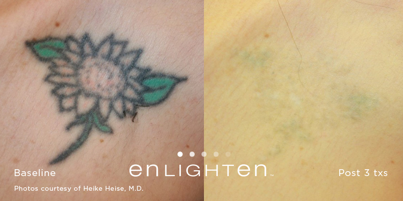 laser-tattoo-removal-before-and-after-sante_3 Laser Tattoo Removal Before and After Sante