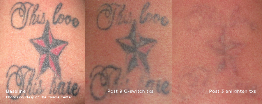laser-tattoo-removal-before-and-after-sante_4 Laser Tattoo Removal Before and After Sante