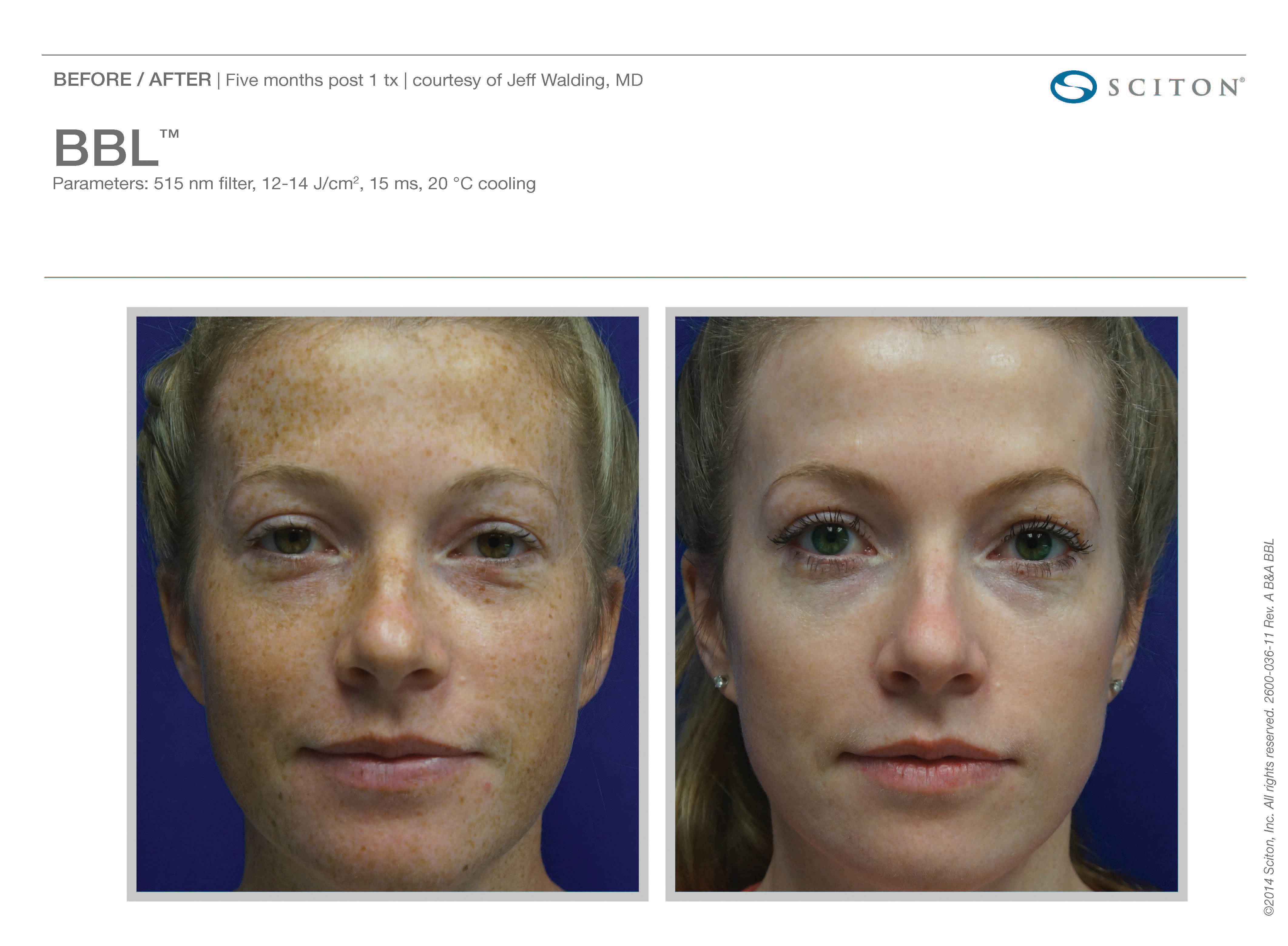 Photofacial Before and After Sante