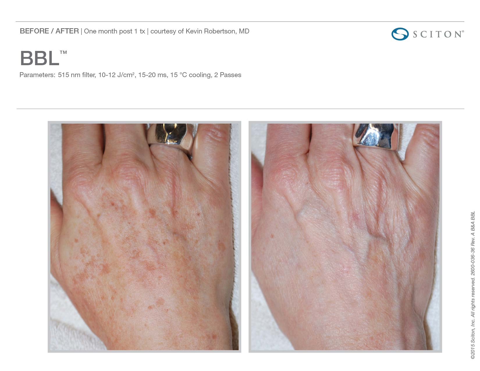 Photofacial Before and After Sante