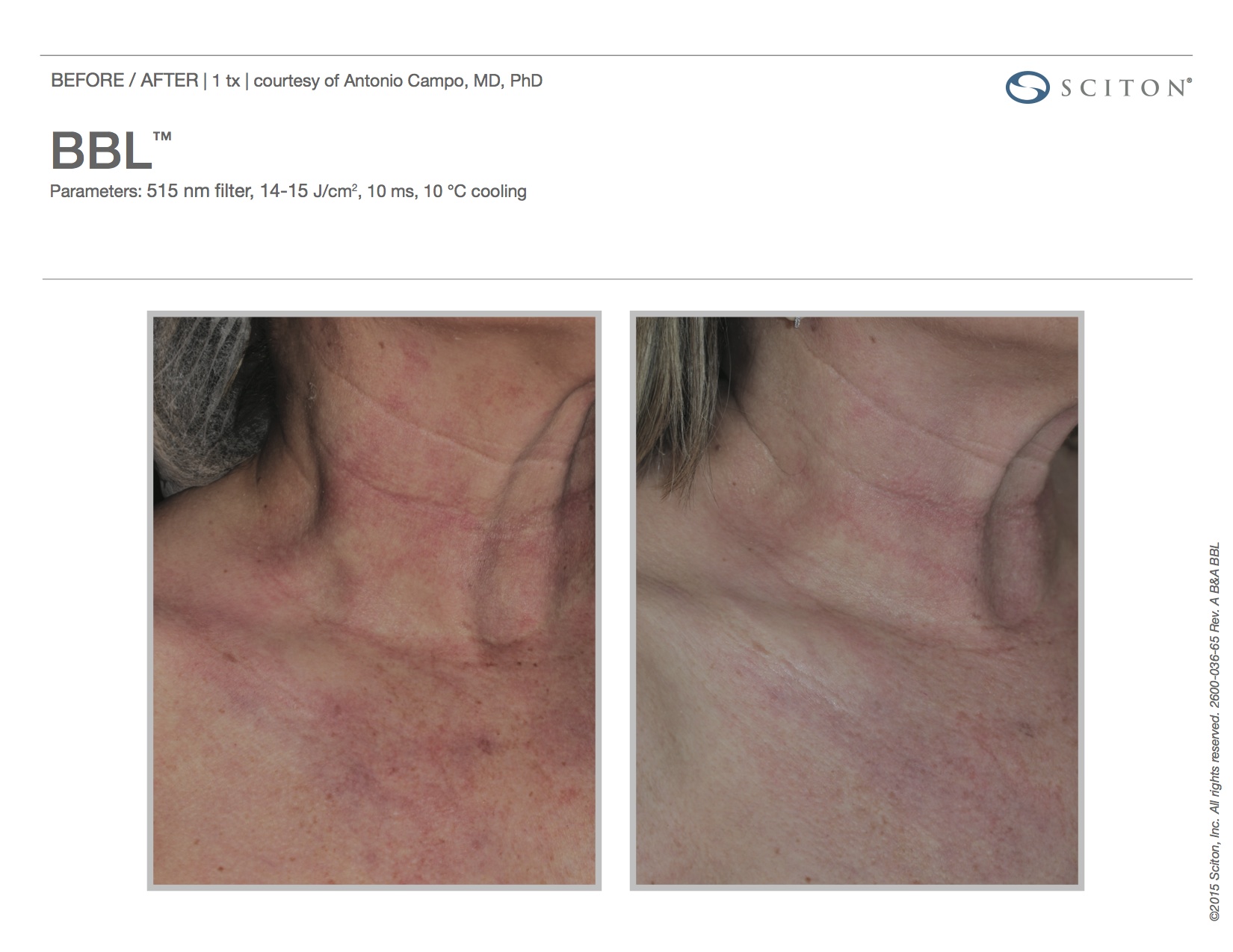 Photofacial Before and After Sante