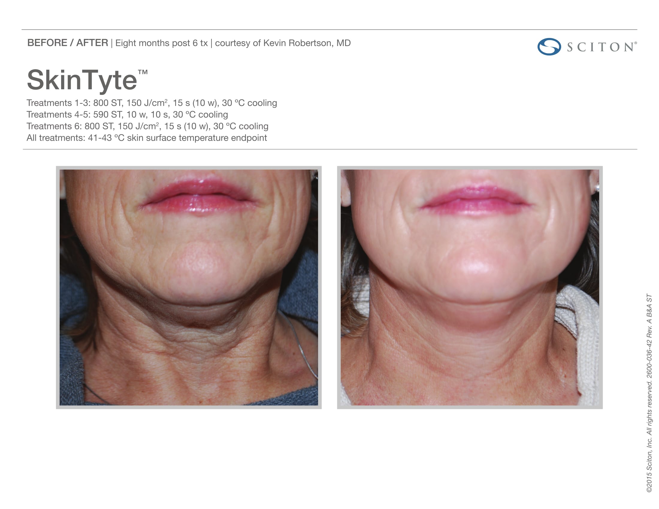 Skin Tyte Laser Before and After Sante