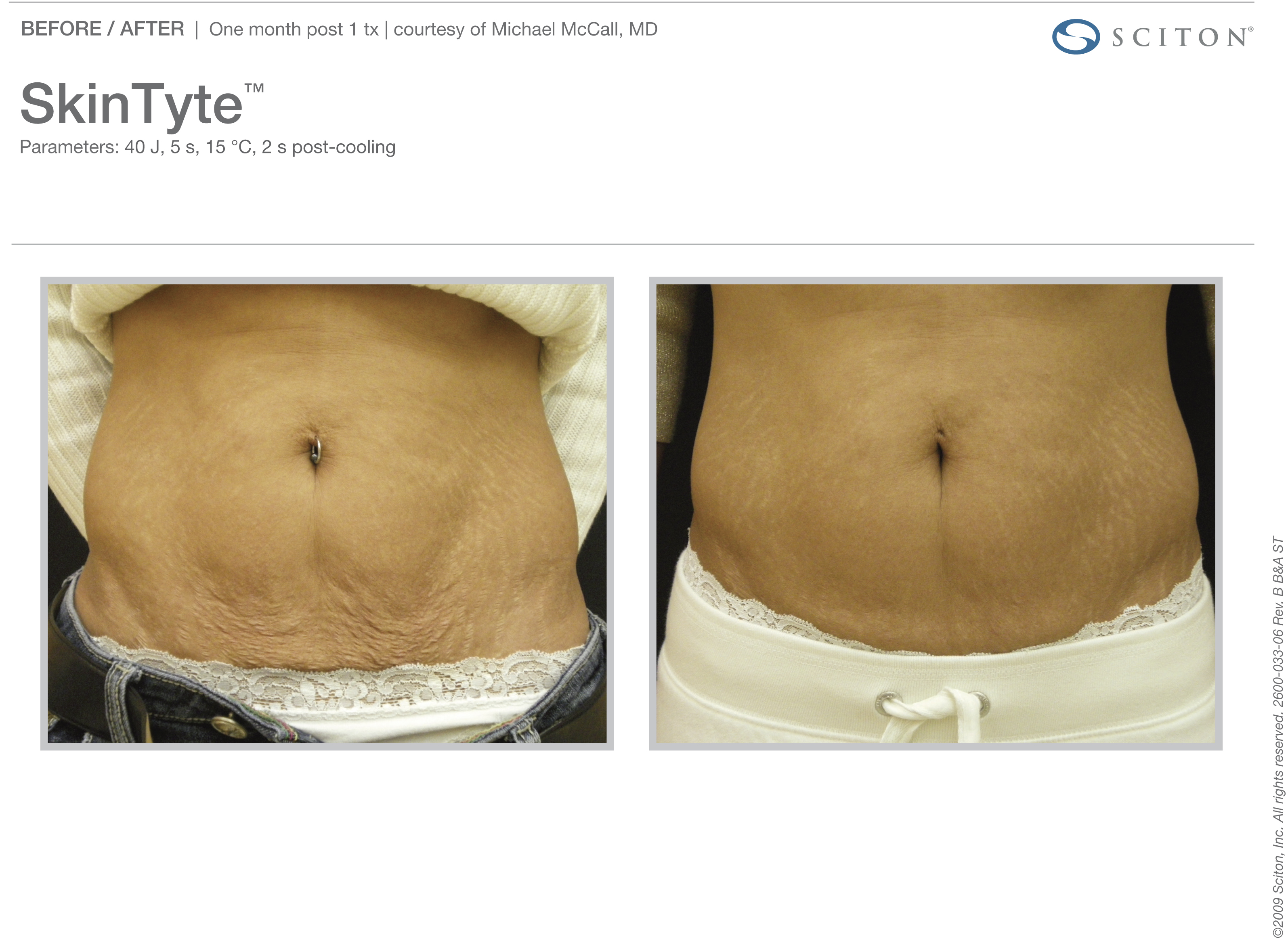 Skin Tyte Laser Before and After Sante