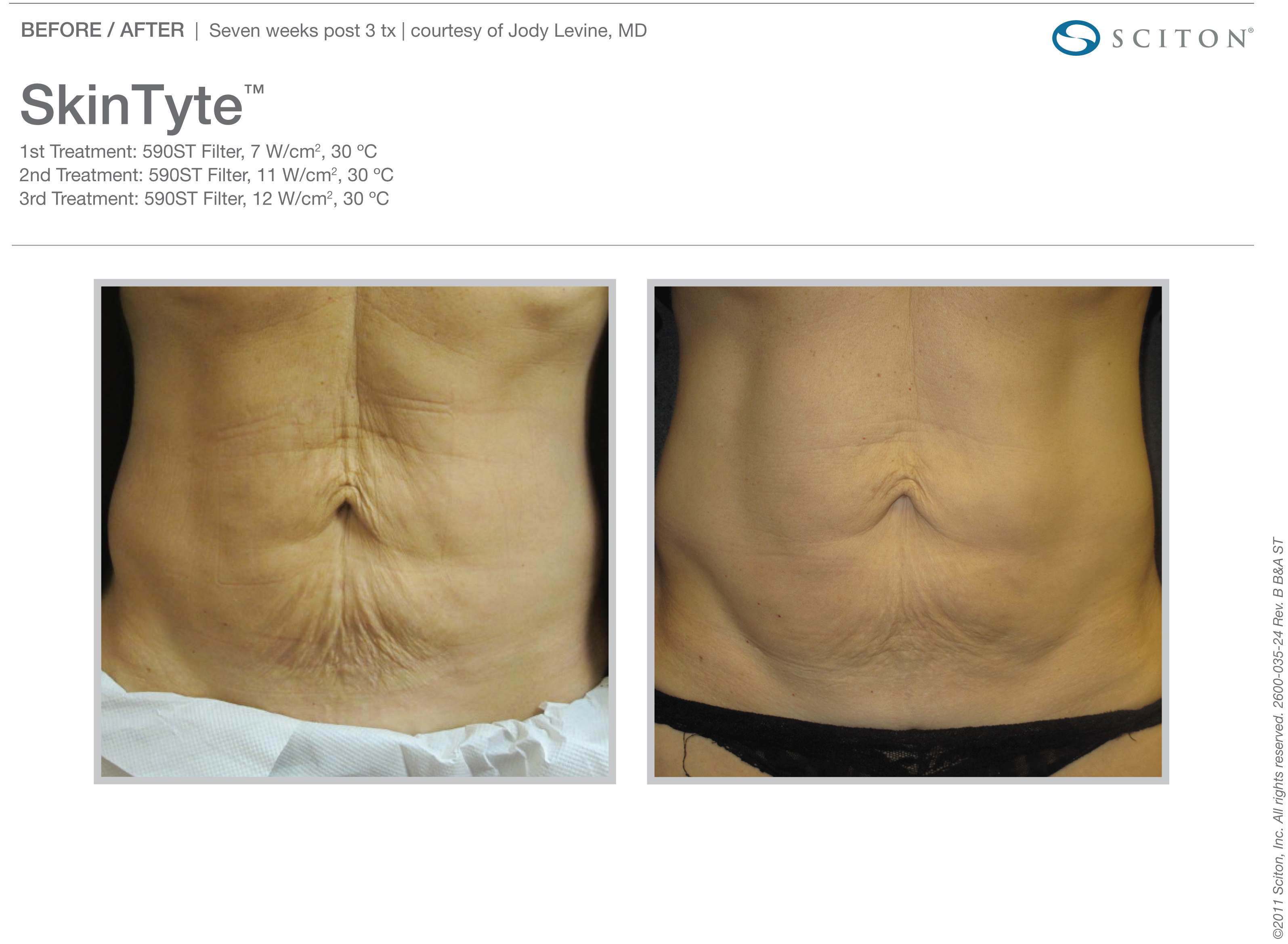 Skin Tyte Laser Before and After Sante