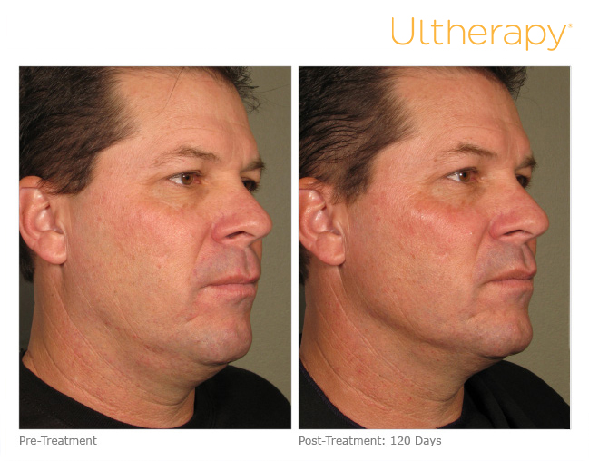 Ultherapy Before and After Sante Ultherapy Before and After Sante