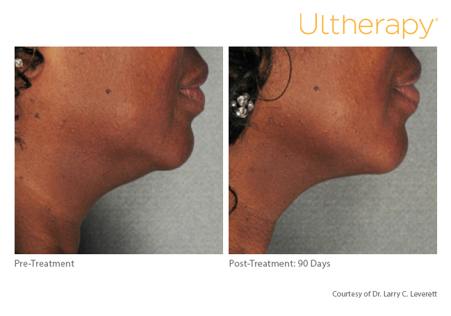 Ultherapy Before and After Sante Ultherapy Before and After Sante